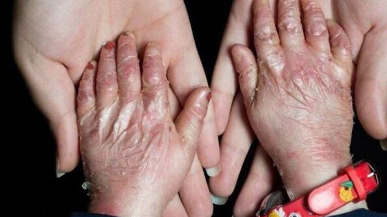 حدود ۲ میلیون بیمار خاص و صعب‌العلاج تحت پوشش بیمه پایه هستند