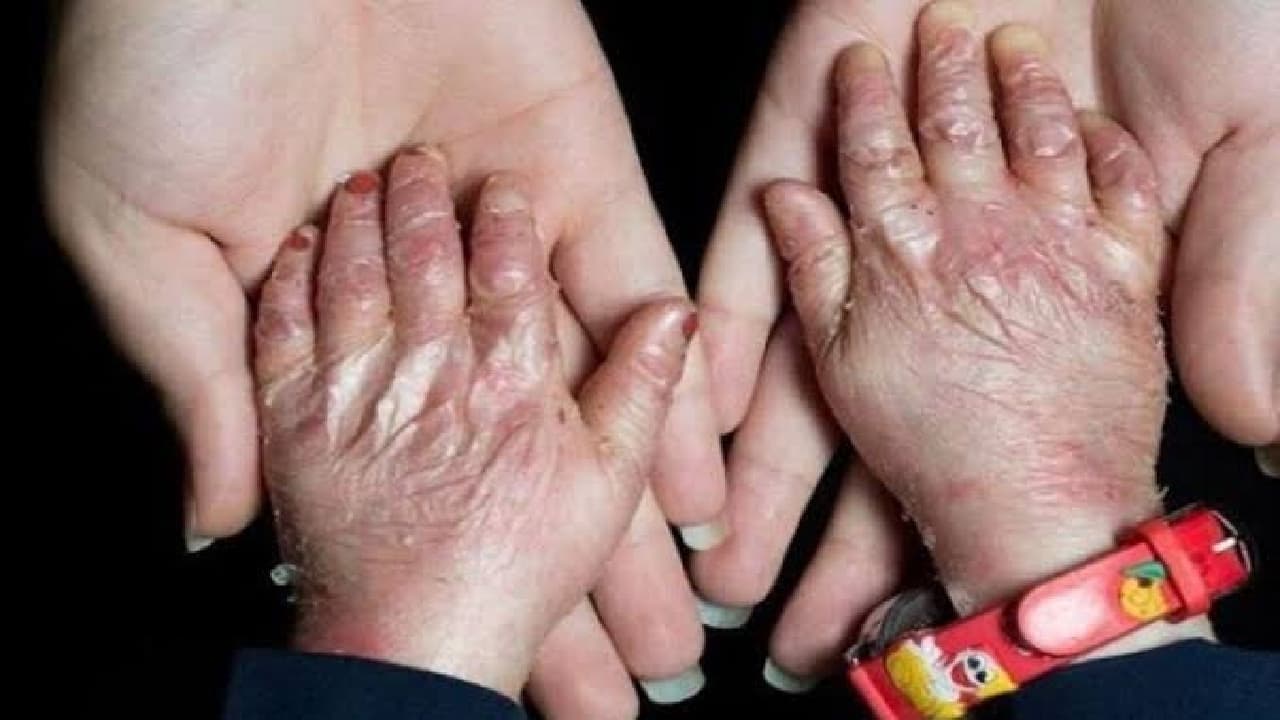 ضرورت اجرای سند ملی بیماری‌های نادر/ ۳۸۸ بیماری نادر تحت پوشش بیمه نیستند