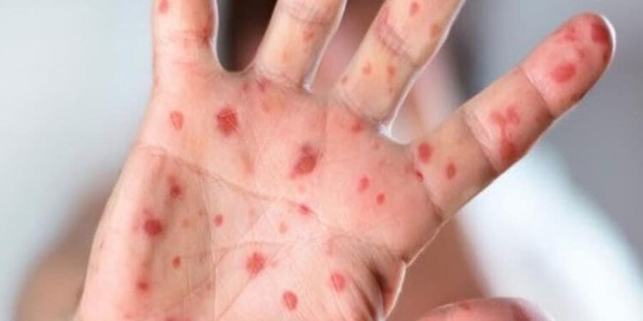 شیوع سرخک در جاسک هرمزگان؛ واکسن موجود است