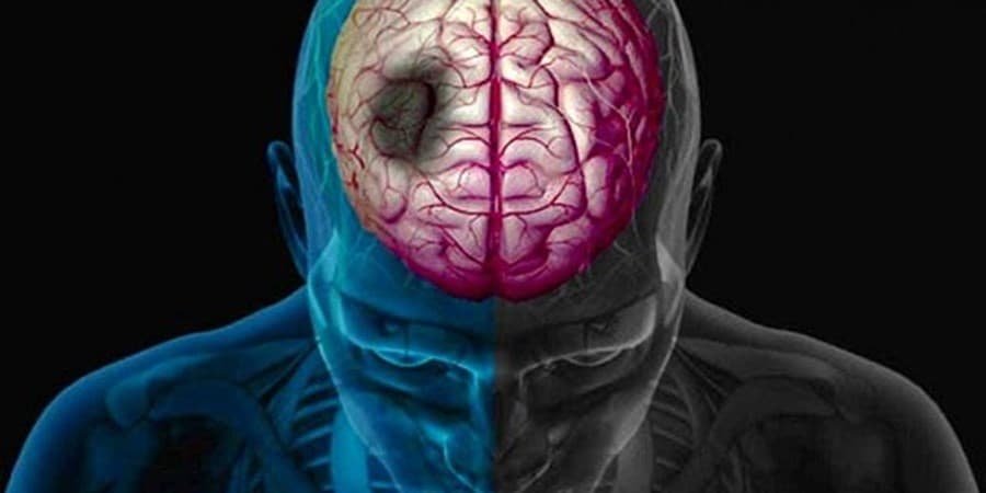 وضعیت بروز سکته مغزی در ایران