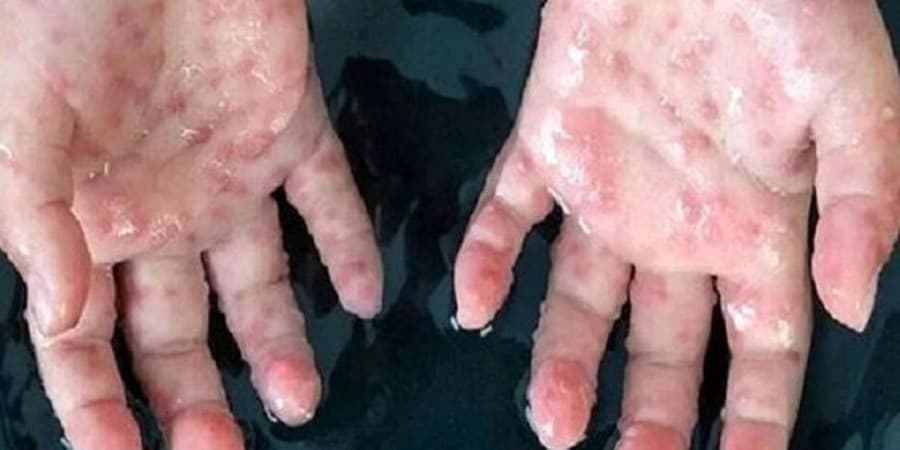 شناسایی مورد جدید سویه Ib آبله میمون در بریتانیا
