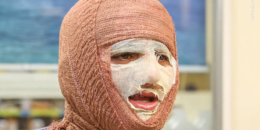 وقوع سالانه 300هزار مورد سوختگی/ تخت سوختگی استاندارد دولتی نداریم