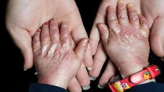 ضرورت اجرای سند ملی بیماریهای نادر/ ۳۸۸ بیماری نادر تحت پوشش بیمه نیستند